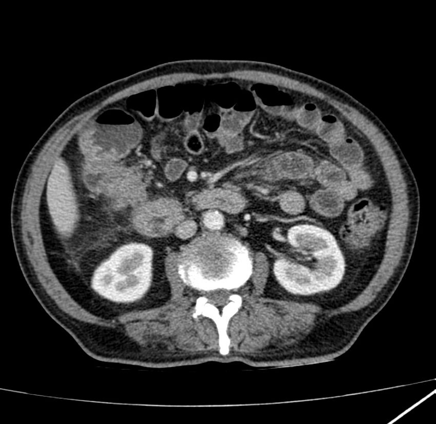 Adenocarcinoma of colon with entero-colic fistula (Radiopaedia 22832-22852 Axial C+ portal venous phase 36).jpg