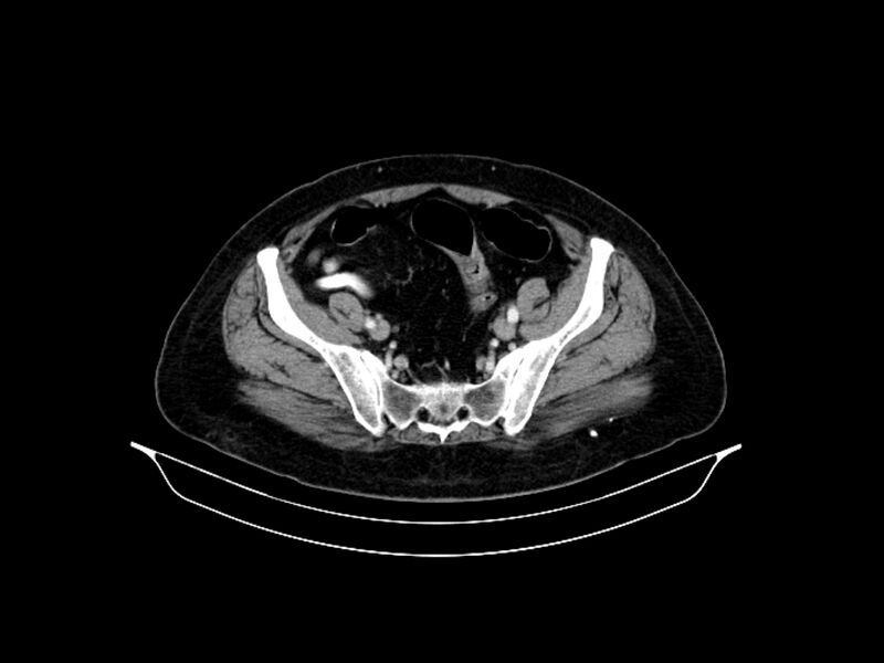 File:Adenocarcinoma of pancreas with hepatic metastasis (Radiopaedia 64332-73122 Axial C+ portal venous phase 82).jpg