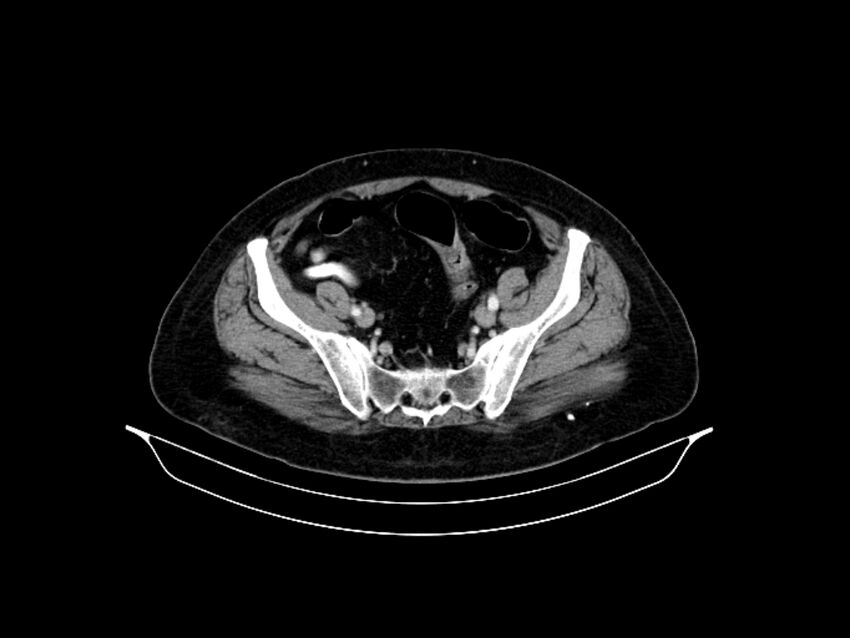Adenocarcinoma of pancreas with hepatic metastasis (Radiopaedia 64332-73122 Axial C+ portal venous phase 82).jpg