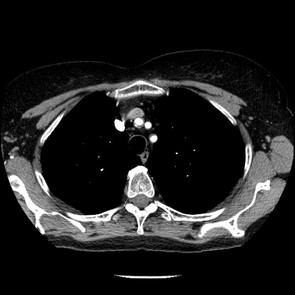 File:Adenocarcinoma of the lung (Radiopaedia 41015-43755 Axial C+ portal venous phase 26).jpg