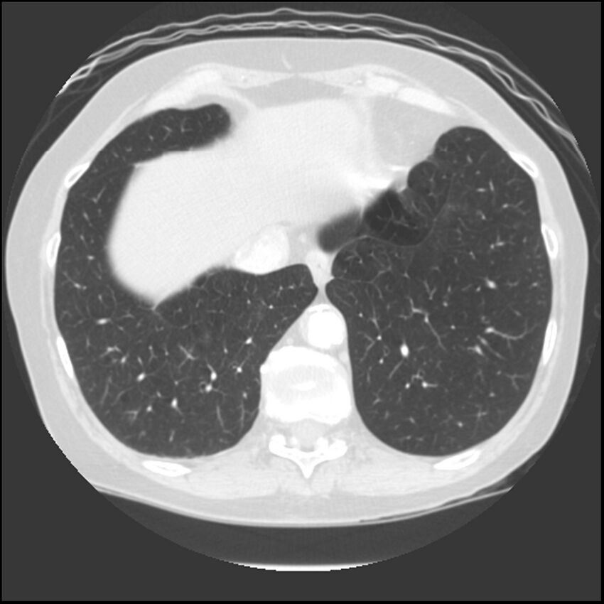Adenocarcinoma of the lung (Radiopaedia 41015-43755 Axial lung window 99).jpg