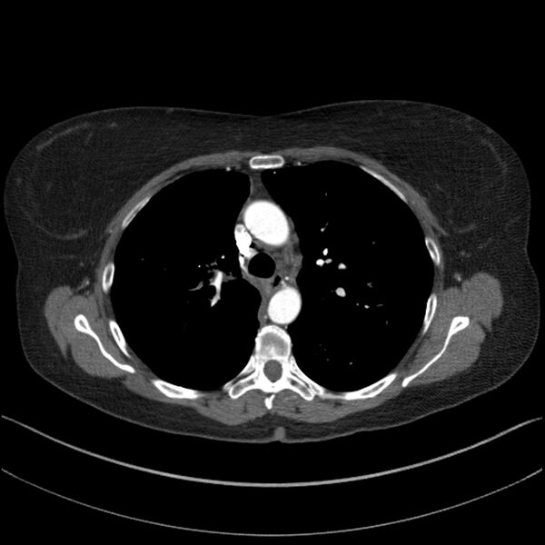 File:Adenocarcinoma of the lung (Radiopaedia 44205-47803 Axial C+ portal venous phase 30).jpg