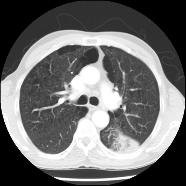 File:Adenocarcinoma of the lung - micropapillary predominant (Radiopaedia 42446-45563 Axial lung window 28).jpg