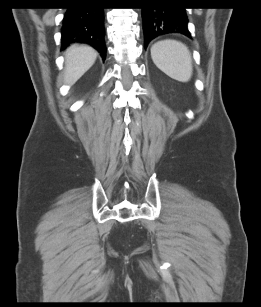 File:Adenocarcioma of rectum- T1 lesion (Radiopaedia 36921-38547 Coronal C+ portal venous phase 52).png