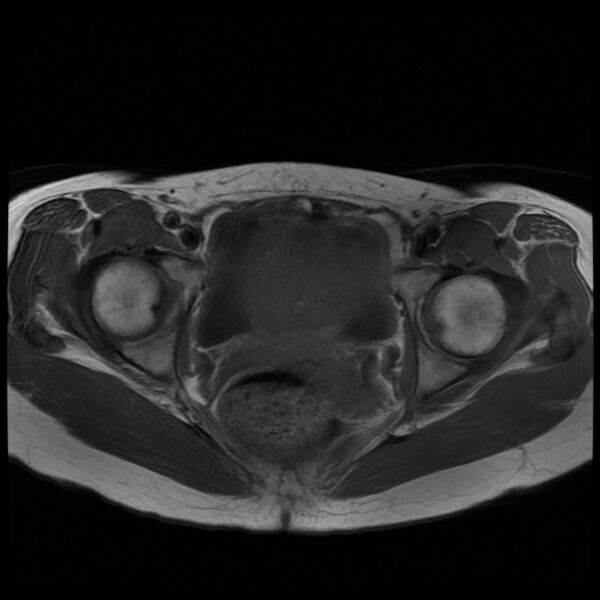 File:Adenomyosis on MRI (Radiopaedia 29328-29780 Axial T1 8).jpg