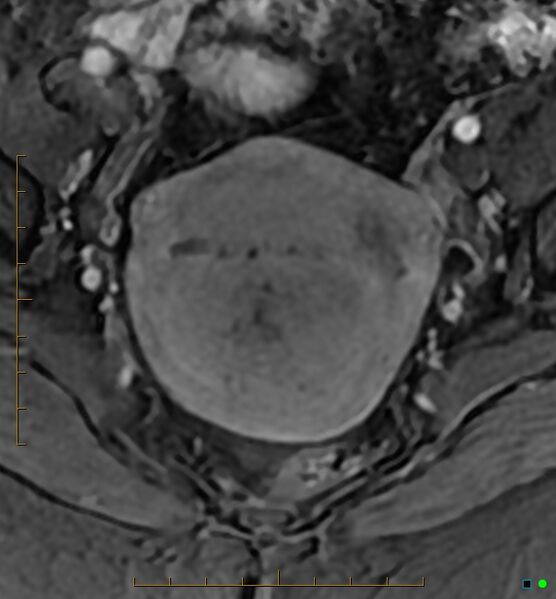 File:Adenomyosis uterus with hematometra (Radiopaedia 45779-50011 Axial T1 C+ fat sat 23).jpg