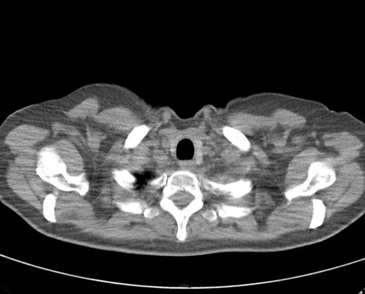 File:Adenosquamous lung carcinoma (Radiopaedia 22035-22030 non-contrast 12).jpg