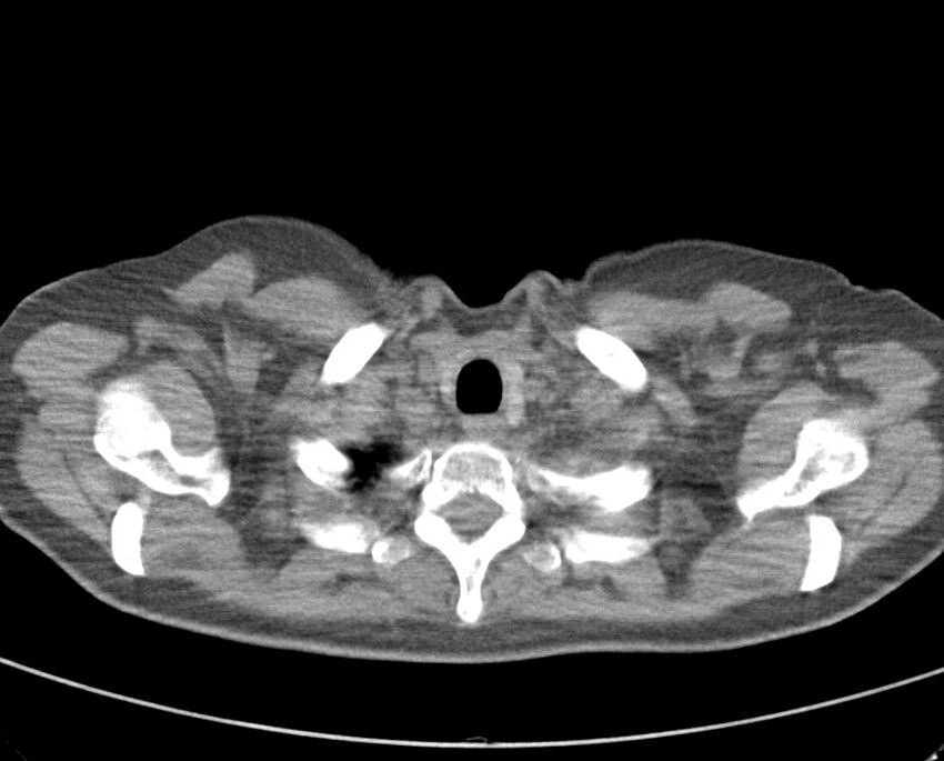 Adenosquamous lung carcinoma (Radiopaedia 22035-22030 non-contrast 12).jpg