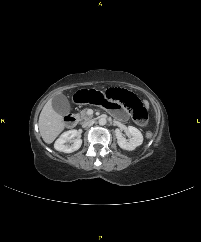 Adhesional small bowel obstruction (Radiopaedia 85402-101024 Axial C+ portal venous phase 108).jpg
