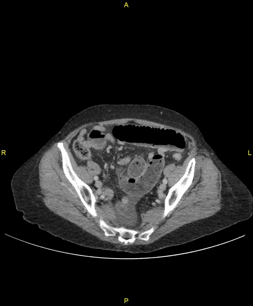 Adhesional small bowel obstruction (Radiopaedia 85402-101024 Axial C+ portal venous phase 226).jpg