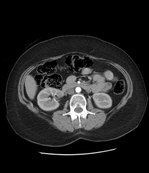 File:Adrenal cortical carcinoma with IVC invasion and thrombosis (Radiopaedia 34307-35597 Axial C+ arterial phase 41).jpg