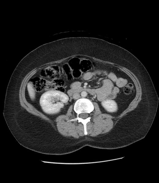 File:Adrenal cortical carcinoma with IVC invasion and thrombosis (Radiopaedia 34307-35597 Axial C+ portal venous phase 43).jpg
