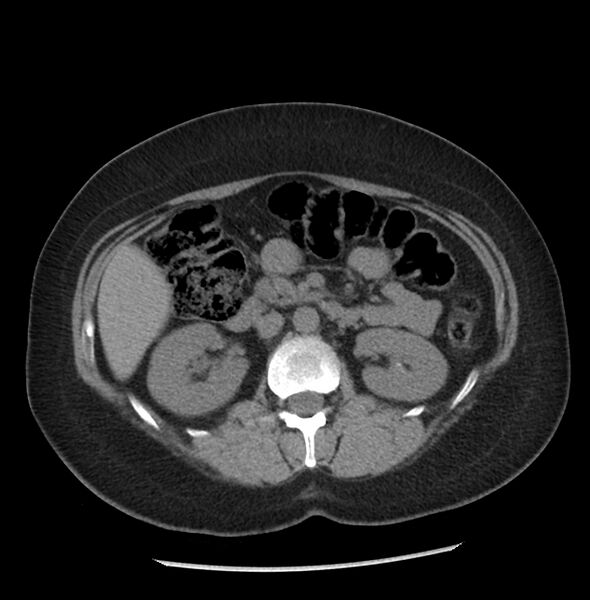 File:Adrenal cortical carcinoma with IVC invasion and thrombosis (Radiopaedia 34307-35597 Axial non-contrast 25).jpg