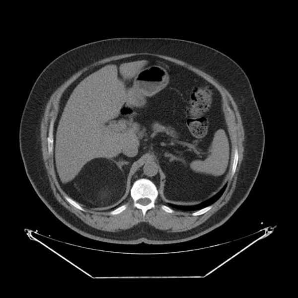 File:Adrenal myelolipoma (Radiopaedia 26278-26407 Axial non-contrast 16).jpg