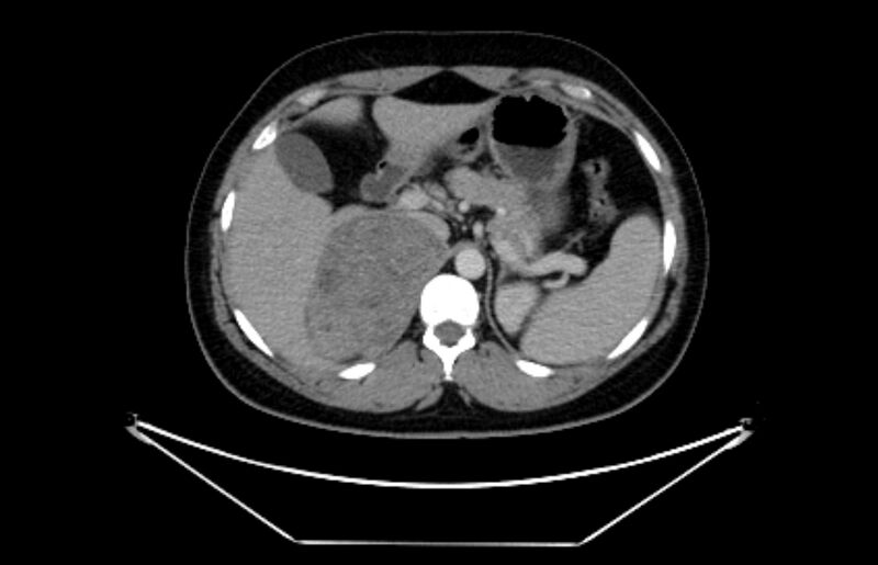 File:Adrenocortical carcinoma (Radiopaedia 80134-93438 Axial C+ portal venous phase 36).jpg