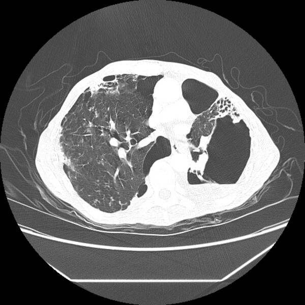 File:Advanced pulmonary tuberculosis (Radiopaedia 8599-9431 Axial lung window 26).jpg
