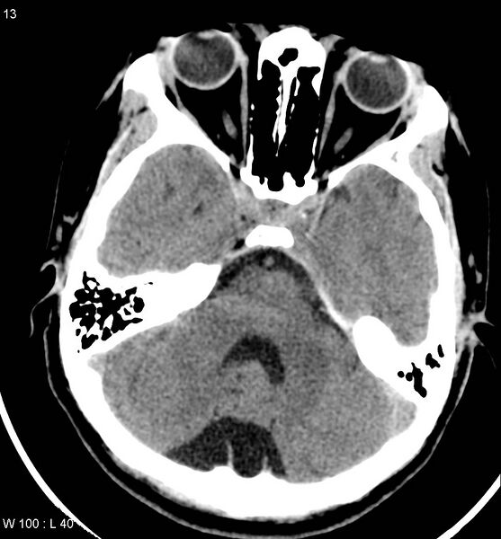 File:Aicardi syndrome (Radiopaedia 5353-7116 Axial non-contrast 10).jpg