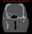 Ameloblastoma (Radiopaedia 13276-13280 Coronal non-contrast 18).jpg