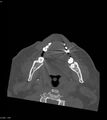 Ameloblastoma (Radiopaedia 18115-17901 Axial bone window 29).jpg