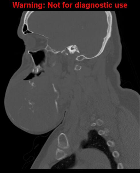 File:Ameloblastoma (Radiopaedia 33126-34164 Sagittal bone window 30).jpg