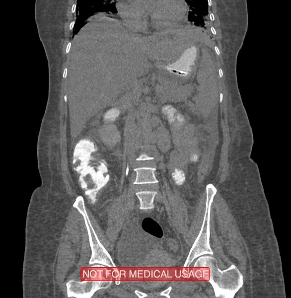 File:Amoebic enterocolitis with liver abscess (Radiopaedia 35100-36609 B 103).jpg