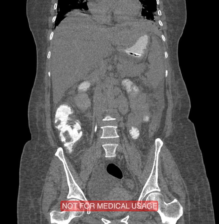 Amoebic enterocolitis with liver abscess (Radiopaedia 35100-36609 B 103).jpg