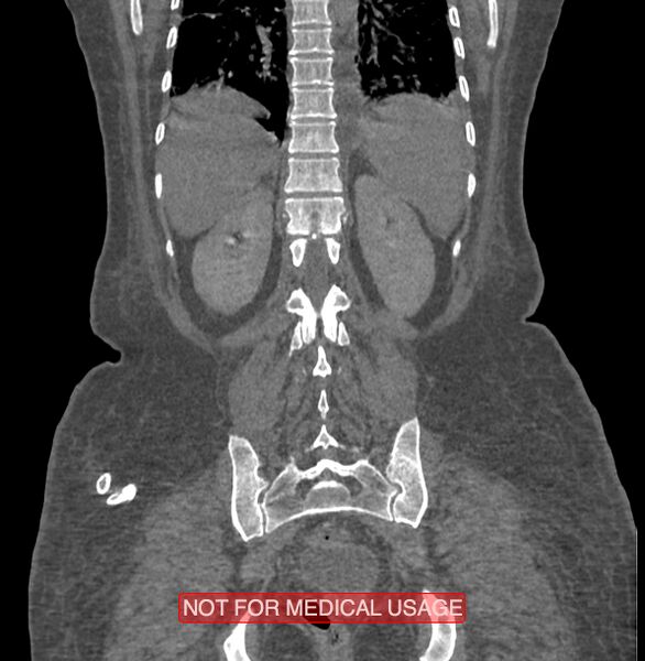 File:Amoebic enterocolitis with liver abscess (Radiopaedia 35100-36609 B 159).jpg