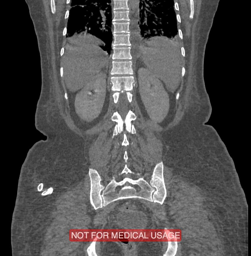 Amoebic enterocolitis with liver abscess (Radiopaedia 35100-36609 B 159).jpg