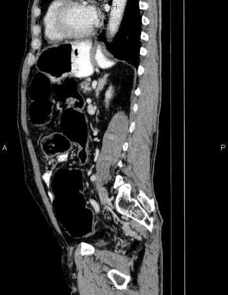 File:Ampullary adenocarcinoma (Radiopaedia 86093-102032 D 62).jpg