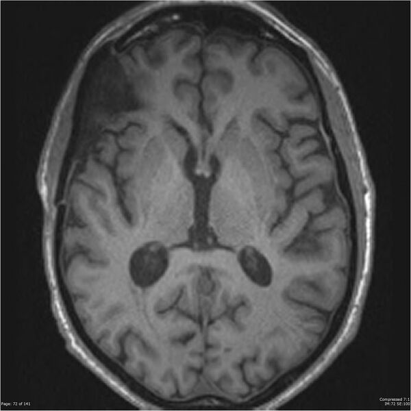 File:Anaplastic meningioma with recurrence (Radiopaedia 34452-35788 Axial T1 70).jpg