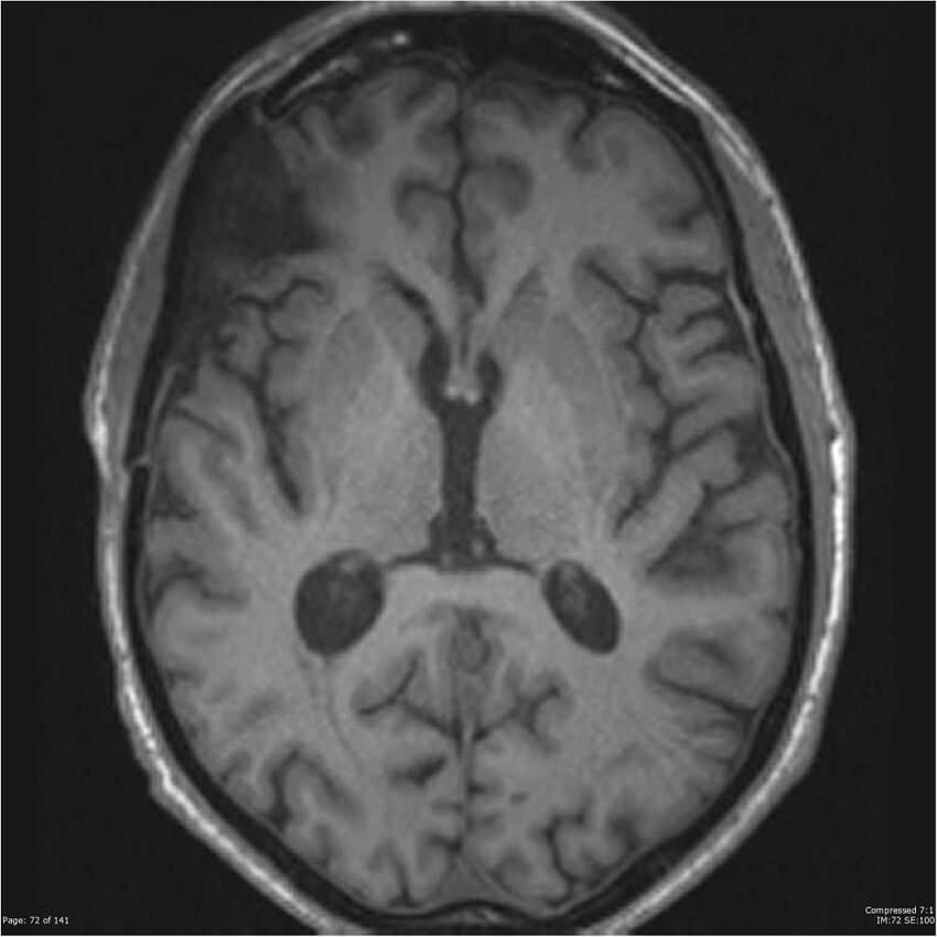 Anaplastic meningioma with recurrence (Radiopaedia 34452-35788 Axial T1 70).jpg