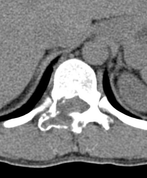 File:Aneurysmal bone cyst T11 (Radiopaedia 29294-29721 Axial non-contrast 42).jpg