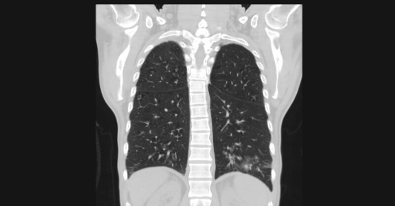 File:Angioinvasive aspergellosis (Radiopaedia 66995-76315 Coronal lung window 47).jpg