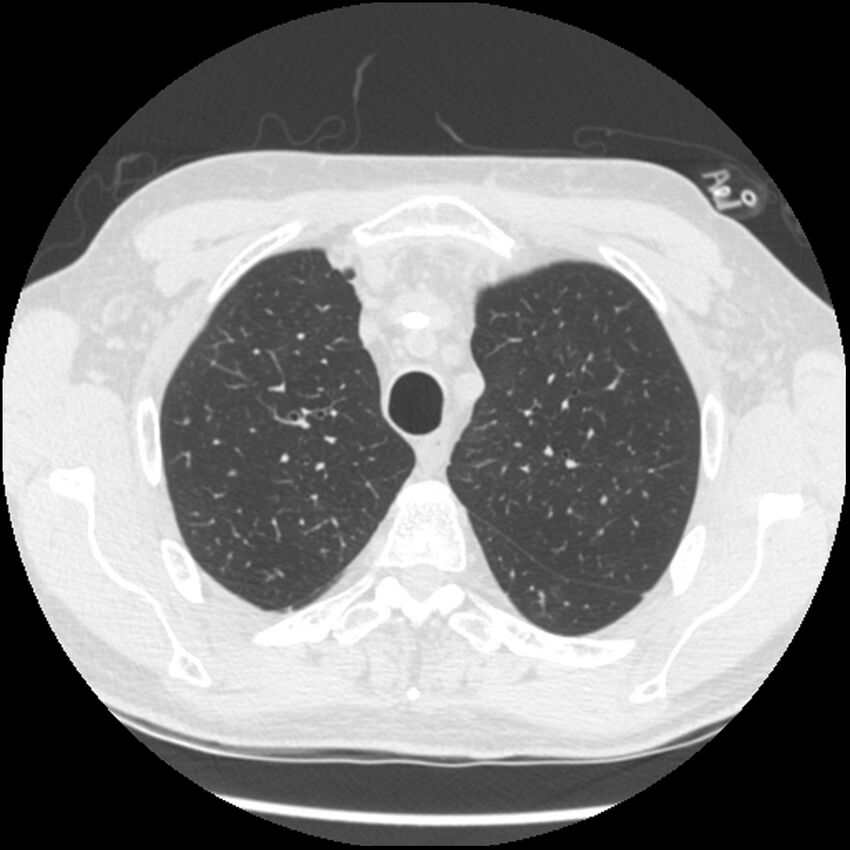 Angioinvasive aspergillosis (Radiopaedia 43957-47466 Axial lung window 17).jpg