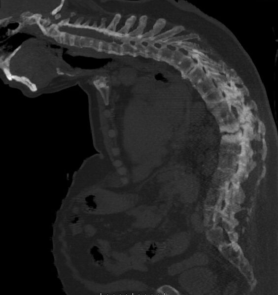 File:Ankylosing spondylitis with pseudoarthrosis (Radiopaedia 17439-17132 bone window 1).jpg