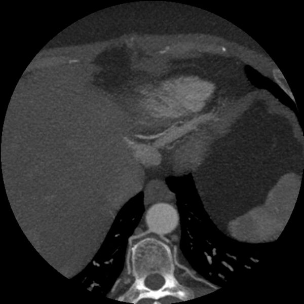 File:Anomalous origin of left circumflex artery from right coronary sinus (Radiopaedia 72563-83117 A 5).jpg