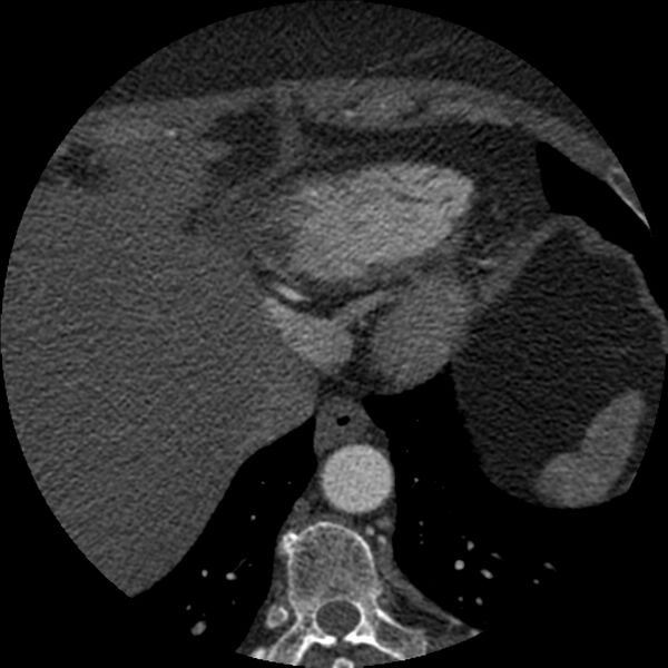 File:Anomalous origin of left circumflex artery from right coronary sinus (Radiopaedia 72563-83117 B 157).jpg