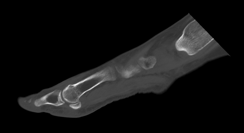 File:Anterior calcaneal process fracture (Radiopaedia 47384-51989 Sagittal bone window 25).png