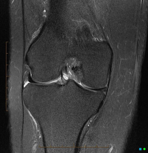 File:Anterior cruciate ligament ganglion cyst (Radiopaedia 3582-6491 Coronal PD fat sat 2).jpg
