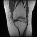 Anterior cruciate ligament tear, Wrisberg rip and bucket-handle tear of medial meniscus (Radiopaedia 75872-87266 Coronal T1 11).jpg