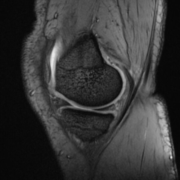 File:Anterior cruciate ligament tear - ramp lesion (Radiopaedia 71883-82322 Sagittal T2 fat sat 19).jpg