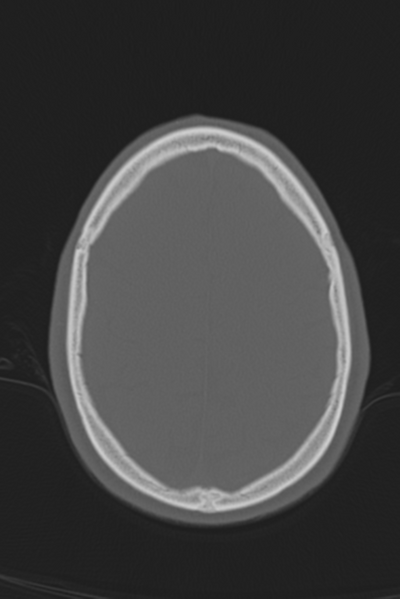 File:Anterior nasal spine fracture (Radiopaedia 46138-50494 Axial bone window 17).png