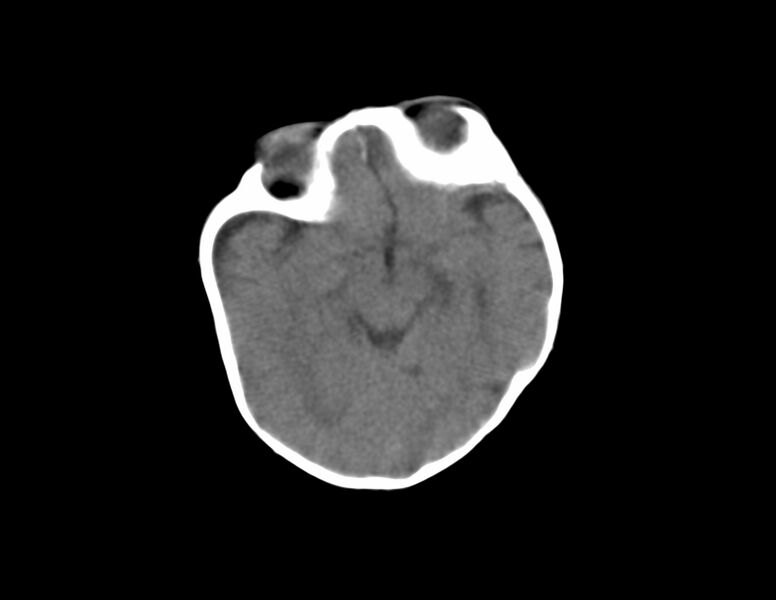 File:Anterior plagiocephaly (Radiopaedia 71836-82273 Axial non-contrast 8).jpg
