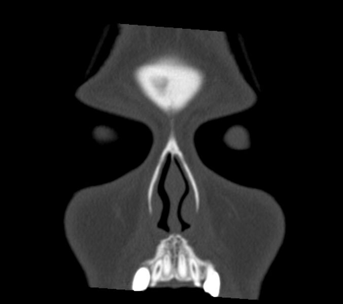 File:Antrochoanal polyp (Radiopaedia 21894-21868 Coronal bone window 1).jpg