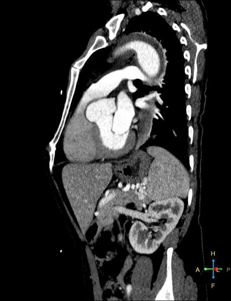 File:Aortic aneurysm and penetrating ulcer (Radiopaedia 23590-23704 C 2).jpg