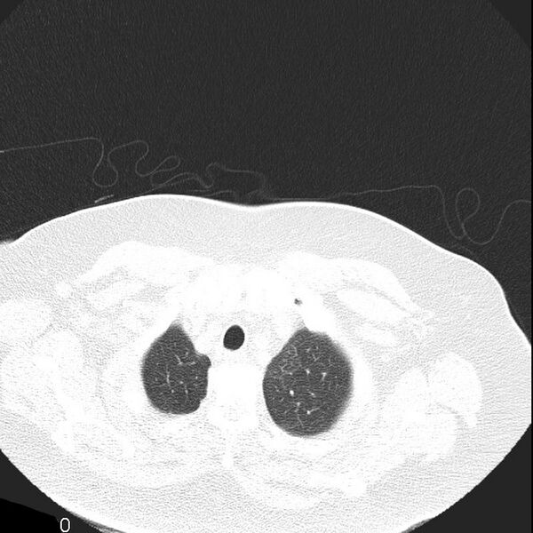 File:Aortic arch false aneurysm (Radiopaedia 14667-14587 Axial lung window 2).jpg