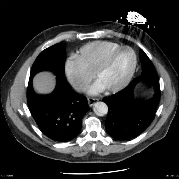 File:Aortic dissection- Stanford A (Radiopaedia 37759-39664 A 49).jpg