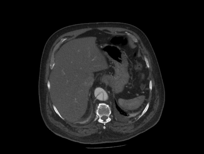 File:Aortic dissection (Radiopaedia 28802-29105 A 38).jpg