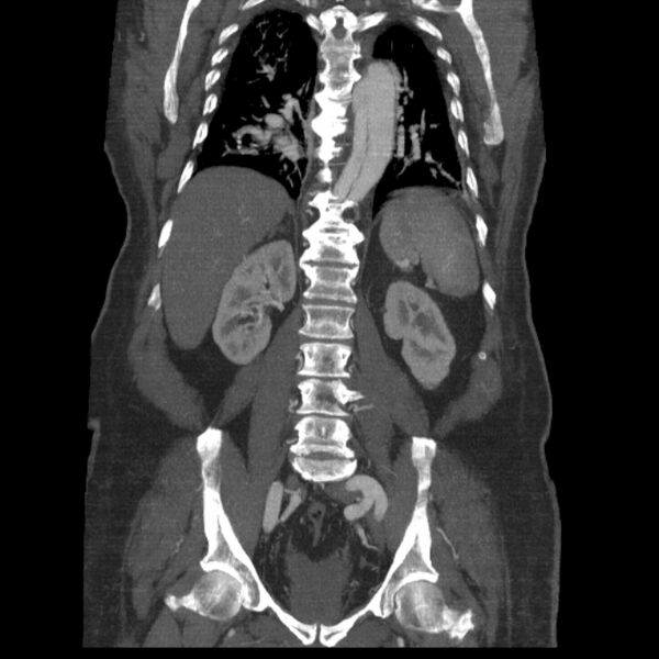 File:Aortic dissection (Radiopaedia 28802-29105 B 27).jpg