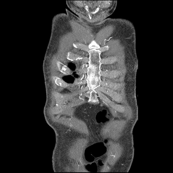 File:Aortic dissection - DeBakey Type I-Stanford A (Radiopaedia 79863-93115 B 6).jpg